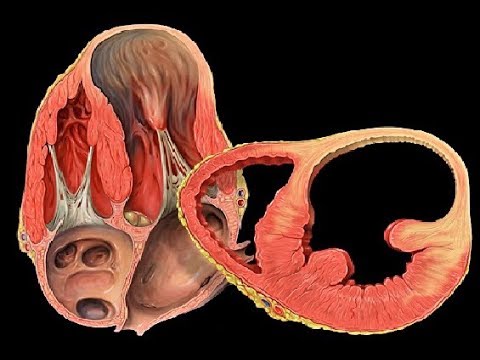 Left Ventricular Aneurysm Repair